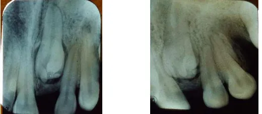 Gambar 3.  Fotografi panoramik sebelum perawatan, tampak benih gigi 21 di dalam tulang alveolar 