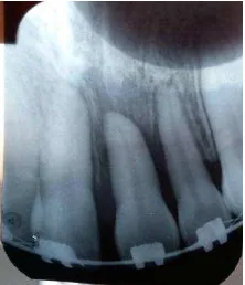 Gambar 5. (A) Hasil pengambilan odontoma kompleks (B) Traksi untuk membantu erupsi gigi 21 setelah pengambilan odontoma secara bedah 