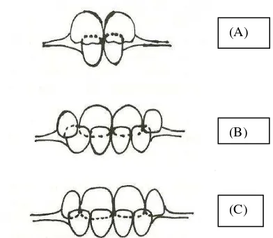 Gambar 1. Pertumbuhan maloklusi kelas III, hubungan gigi anterior selama erupsi gigi desidu (A) Erupsi gigi insisivus sentral, (B) Cros bite gigi insisivus sentral, (C) Cros bite pada semua gigi insisivus.5 