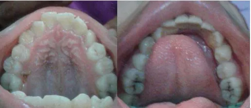 Gambar 3.  Fotografi ekstraoral pasien sebelum perawatan, (A) Tampak samping, (B) Tampak depan,  