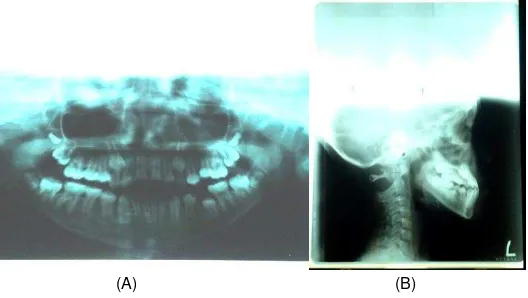 Gambar 5. Foto Intraoral sebelum perawatan, (A) Tampak depan, (B) Tampak samping kanan, (C) Tampak samping kiri 