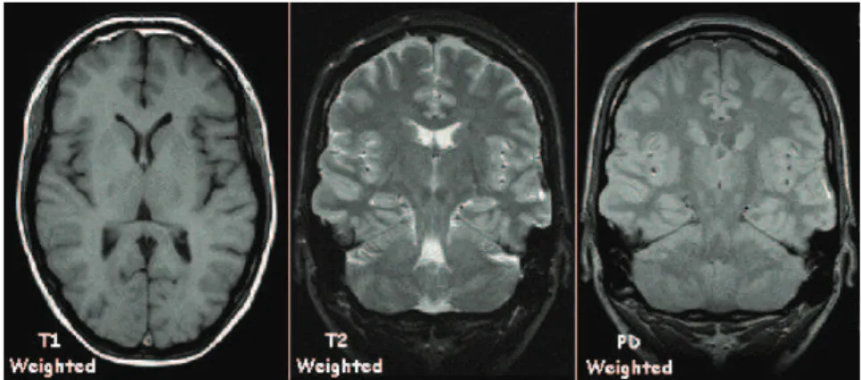 Figure 6: Example of T1-, T2- and a PD-weighted images. The cerebrospinal