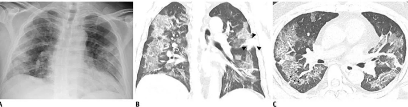 Gambar 2. 14 Gambaran Radiografi Dada (A) Dan CT Yang Representatif (B, C) Dari Pneumonia  COVID-19 Yang Bermanifestasi Sebagai Campuran Opasitas Ground-Glass Konfluen Dan  Konsolidasi Pada CT.A
