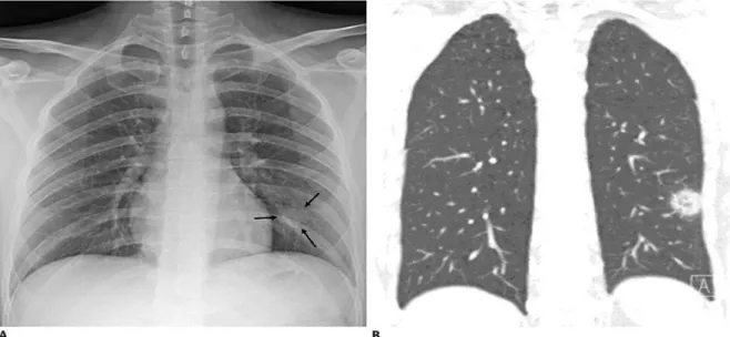 Gambar 2. 16 Gambar Radiografi Dada (A) Dan CT Representatif (B) Dari Pneumonia COVID-19  Yang Bermanifestasi Sebagai Lesi Nodular Tunggal