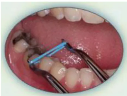 Gambar 4. Pemasangan elastik separator 36 