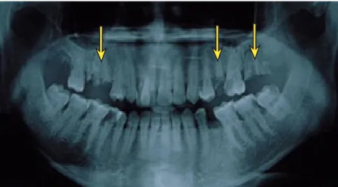Gambar 1.  Sisa akar gigi (tanda panah) merupakan sumber infeksi.