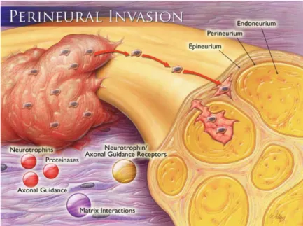 Gambar 2.1 Invasi perineural (Liebig, et al., 2009) 