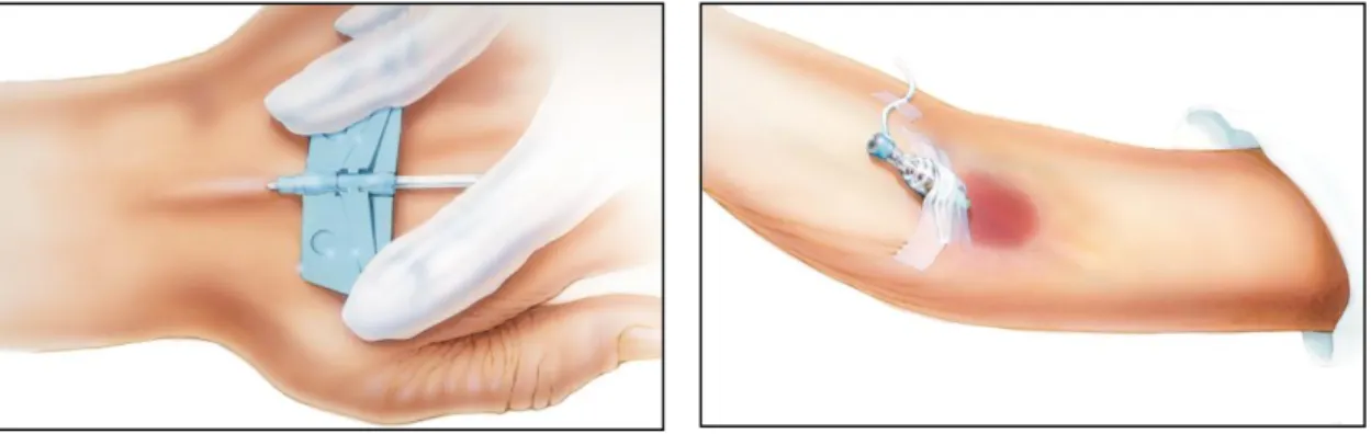 Tabel 2.5. Skala Flebitis menurut Infusion Nursing Standard 2011   (Becton Dickinson, 2015) 