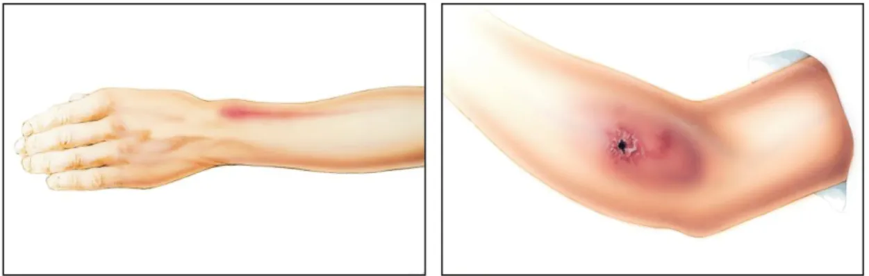 Gambar 2.1. Gambaran Flebitis (Becton Dickinson, 2015)  2.2.5.   Pengobatan Flebitis 