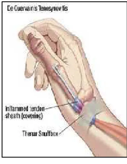 Gambar 3. inflamasi tendo sheath