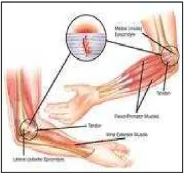 Gambar 4. Lateral epicondylitis