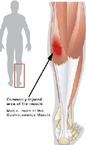 Gambar 2. Cedera Strain Tungkai 