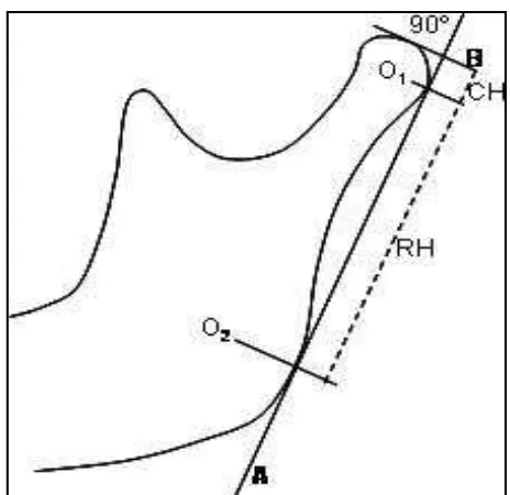 Gambar 6. Pengukuran tinggi kondilus danramus berdasarkan metode Habetsdkk.,2