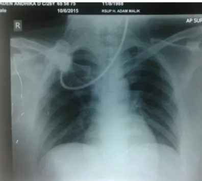 Foto thorax tidak ada kelainan 