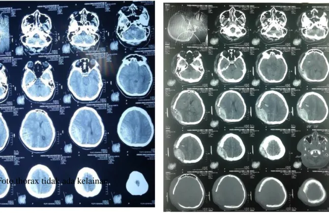 Foto thorax tidak ada kelainan 
