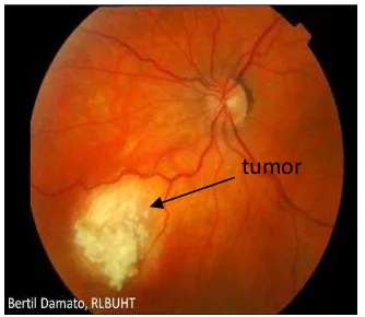 Gambar 2.3. Fundus retina dengan Retinoblastoma. 