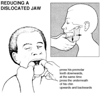 Gambar 11:Luksasi mandibula 