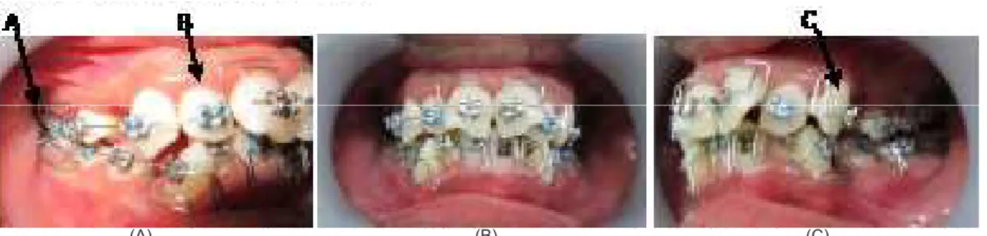 Gambar 2. Foto insersi alat dengan multiloop edgewise archwire, (A) T-Loop, (B) L-Loop, (C) vertikal loop