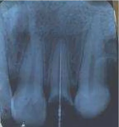 Gambar 2. Radiograf panjang kerja gigi 21 