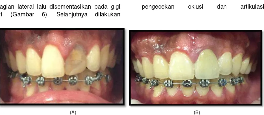 Gambar 6. (A) Tampak klinis keadaan awal gigi 21; (B) Tampak klinis keadaan gigi 21 dan 21 setelah direstorasi
