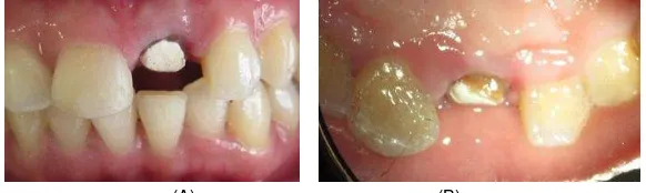 Gambar 4. (A) Hasil akhir eksisi setelah dibersihkan dengan irigasi saline (B) Luka ditutup periodontal pack 