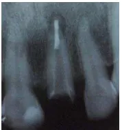 Gambar 8. (A) Sementasi custom dowel core dan preparasi tonggak pada gigi 21  (B) Analisis radiograf pasca sementasi cutom dowel core 