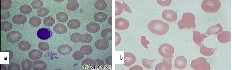 Gambar 2.1 Gambaran mikroskopis hapusan darah (a) normal (b) anemia 