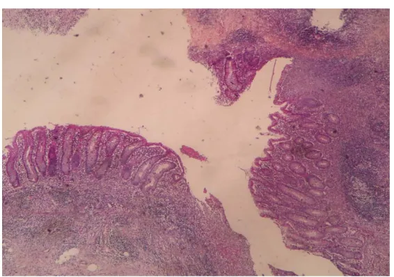Gambar 5.     Sel –sel radang akut pada seluruh ketebalan dinding apendiks disertai     