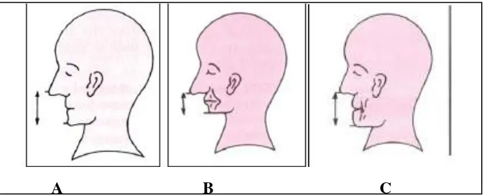 Gambar 6. Tinggi Wajah bagian bawah (A) = Normal (B)= Berkurang (C)= Bertambah20 