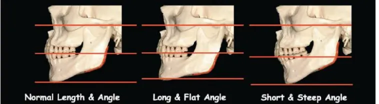 Gambar 1. Perbedaan tinggi wajah bagian bawah dan sudut dataran mandibula karena perbedaan panjang ramus dan besar sudut gonial 2  