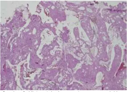 Gambar 3. Histopatologi massa tumor menunjukkan gambaran karsinoma mukoepidermoid. 