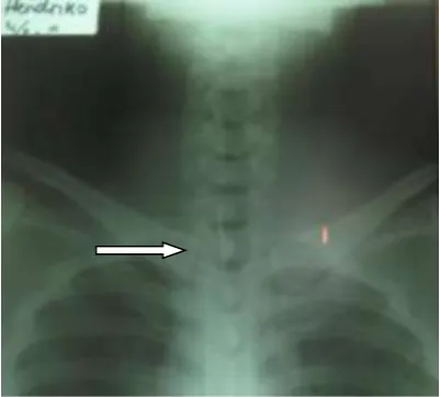 Fig 1 . Cervical anteroposterior radiograph on September, 14th 2010 at 08.50 am. 