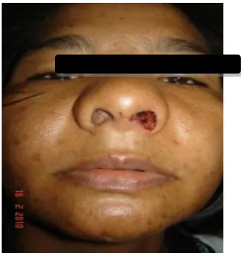 Gambar 4 . Abses septum nasi bilateral saat  pasien masuk rumah sakit 