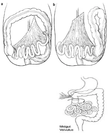 Gambar 1. a. Mesentrika usus normal, b.Malrotasi  