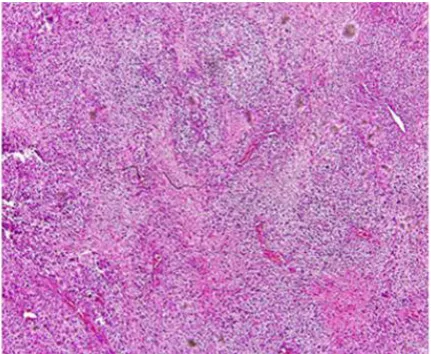 Figure 5. The epithelial component are consist of myxoid, myoepithelial proliferation, with vessel and hystiosit (pleomorphic adenoma)