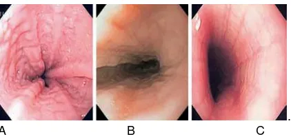 Gambar 3. Gambaran endoskopi eosinofilik esofagitis9