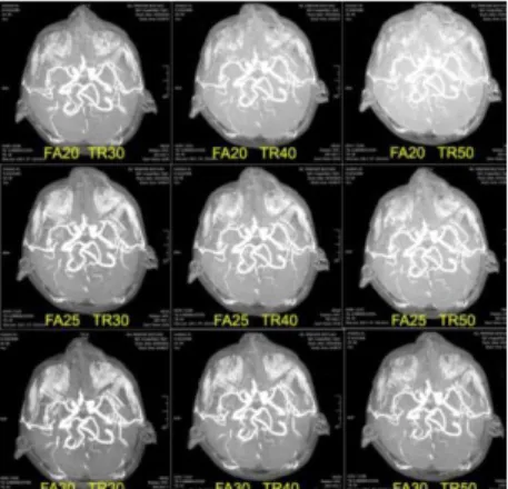 Gambar 1. Citra 3D TOF MRA brain dengan 9 (sembilan)  variasi TR dan flip angle 