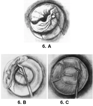 Gambar 5. Atresia liang telinga. A tipe solid B. tipe membran8 