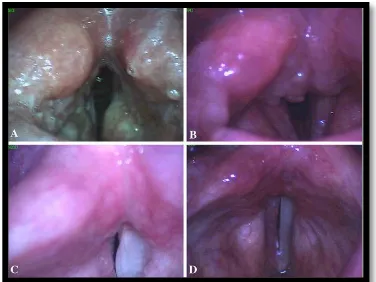 Gambar 2. Hasil pemeriksaan laringoskopi pada TB laring (A) Tipe ulseratif, pada rongga laring (B) Tipe granulomatosa, pada bagian posterior glotis (C) Tipe polipoid, pada pita suara palsu kanan (D) Tipe nonspesifik, pada pita suara kanan8 