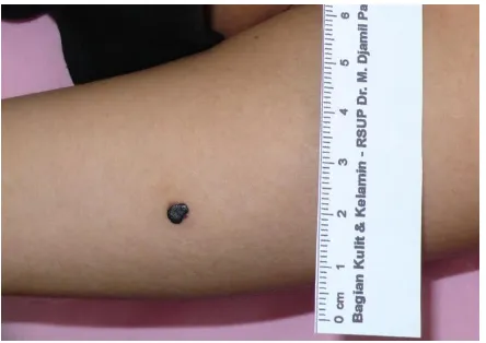 Figure 1. Black pimple on the right lower arm 