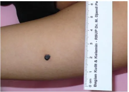 Figure 1. Black pimple on the right lower arm 