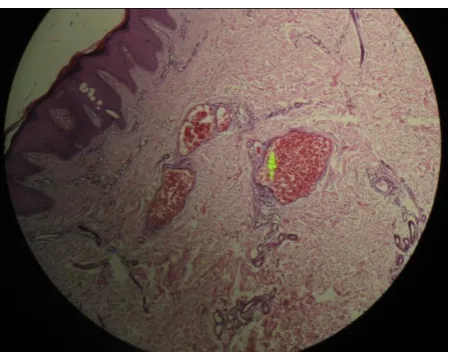 Figure 2.  Histopathology examination: showed thicked-