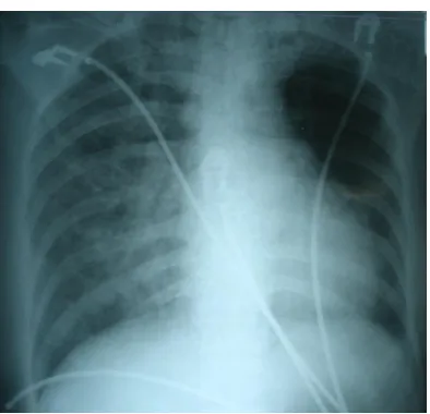 Gambar 2. Rontgen torak pasien dengan CTR 50%, seg Ao normal, Po normal, pinggang jantung mendatar, apex downward, infiltrat lapangan paru kiri dengan kranialisasi 