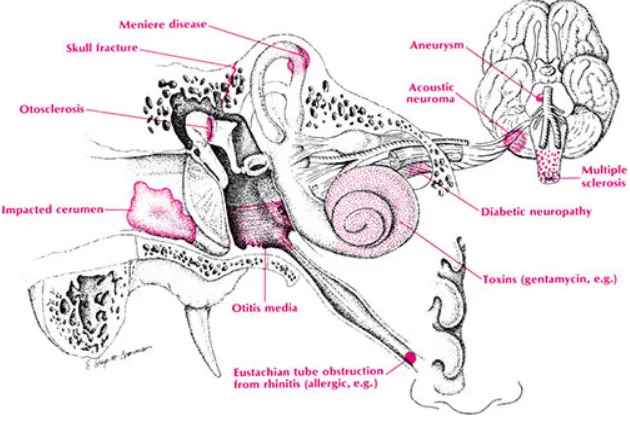 Gambar 2.4 Etiologi tinitus