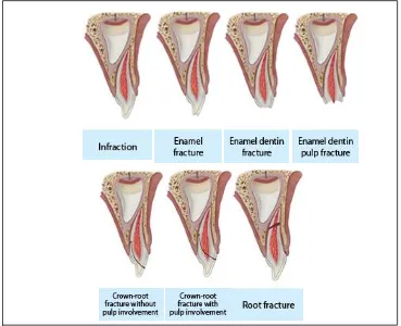 Gambar 1. Kerusakan pada jaringan keras gigi dan pulpa28