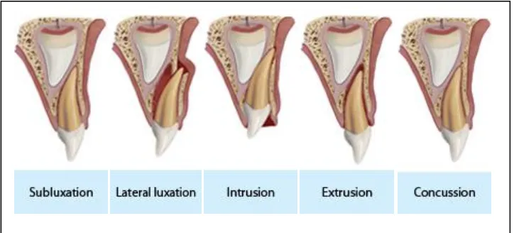 Gambar 2. Kerusakan pada jaringan periodontal28