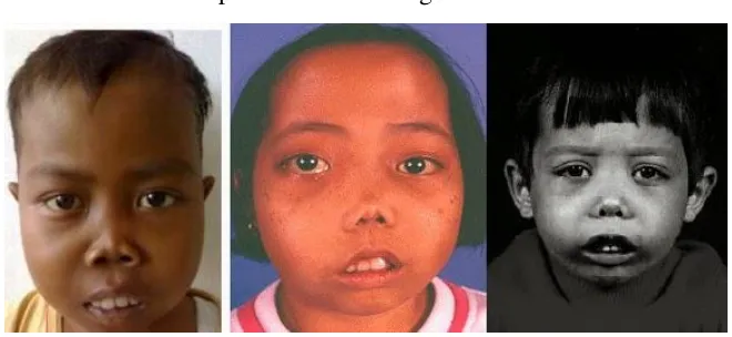 Gambar 2.3 Bentuk Wajah Penderita Thalassemia (thalassemiainfo.blogspot.com) 