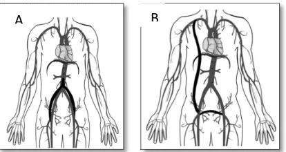 Gambar 5  Bypass Bilateral dari Aorta Abdominalis Infra Renal ke A. Femoralis B,Bypass Axillo Bifemoral1  