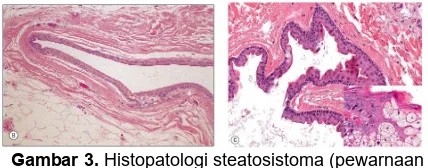 Gambar 4.  Histopatologi steatosistoma (pewarnaan 