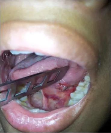 Gambar 11. Kontrol post op 8 september 2014 